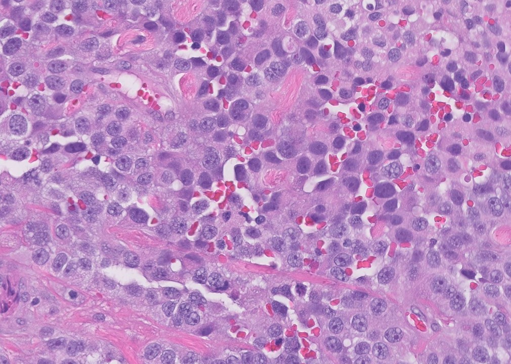 Microscopic image possibly detecting cancerous areas in human tissue