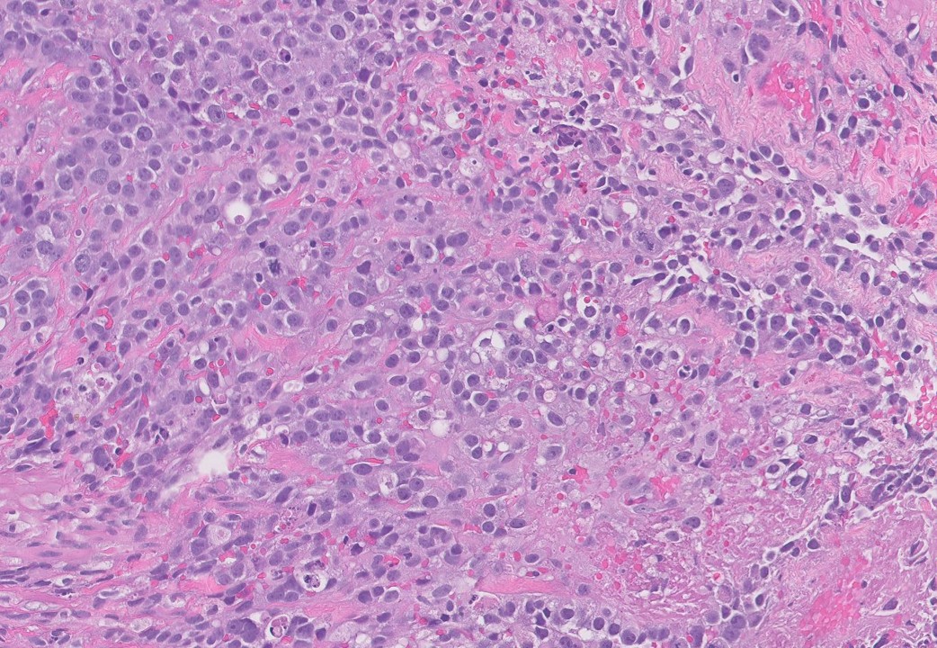 Microscopic image possibly detecting cancerous areas in human tissue