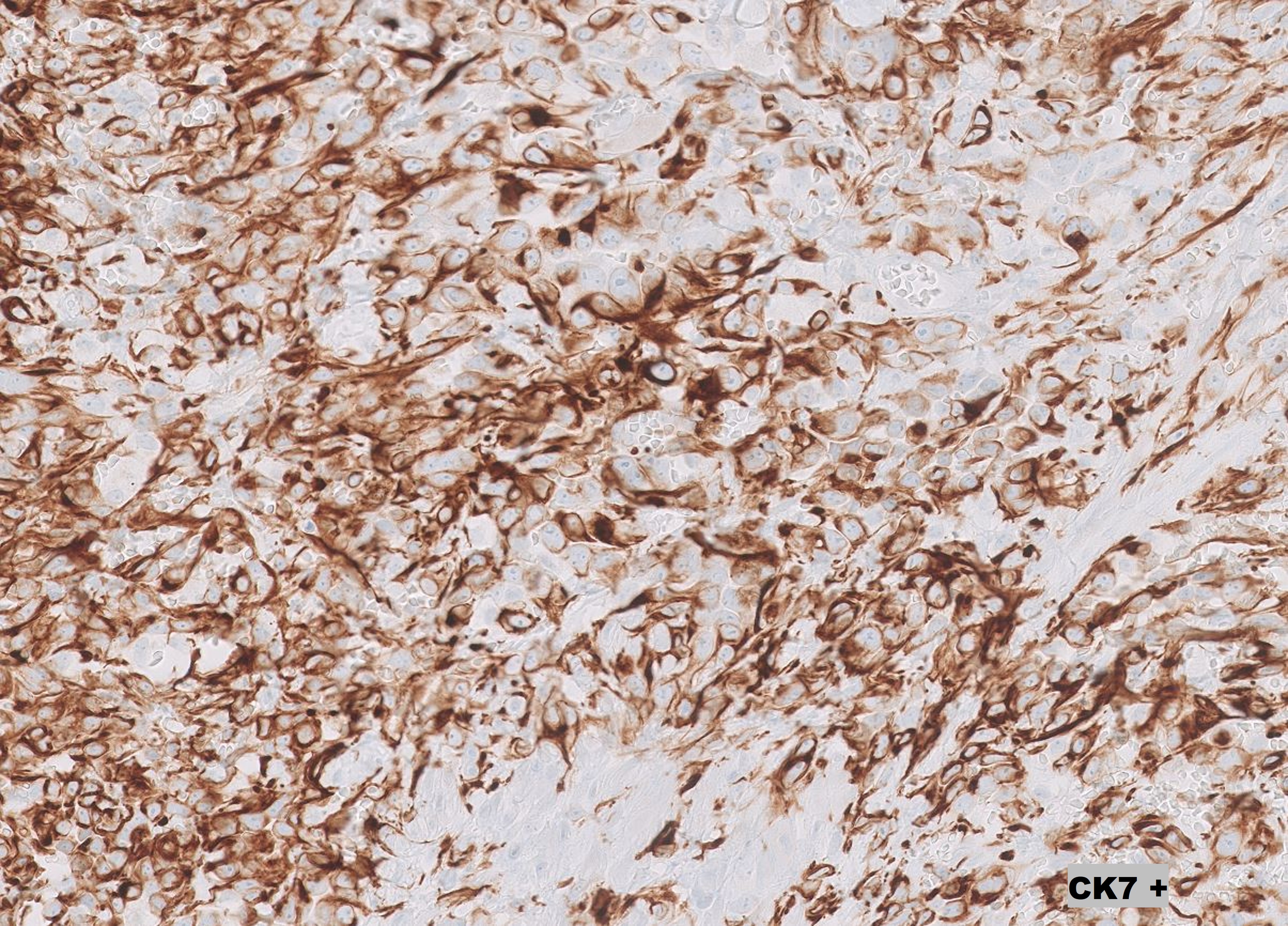 Microscopic image possibly detecting cancerous areas in human tissue