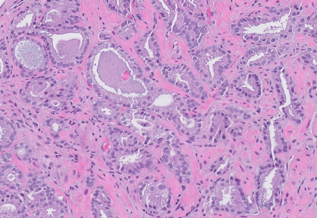 Microscopic image possibly detecting cancerous areas in human tissue