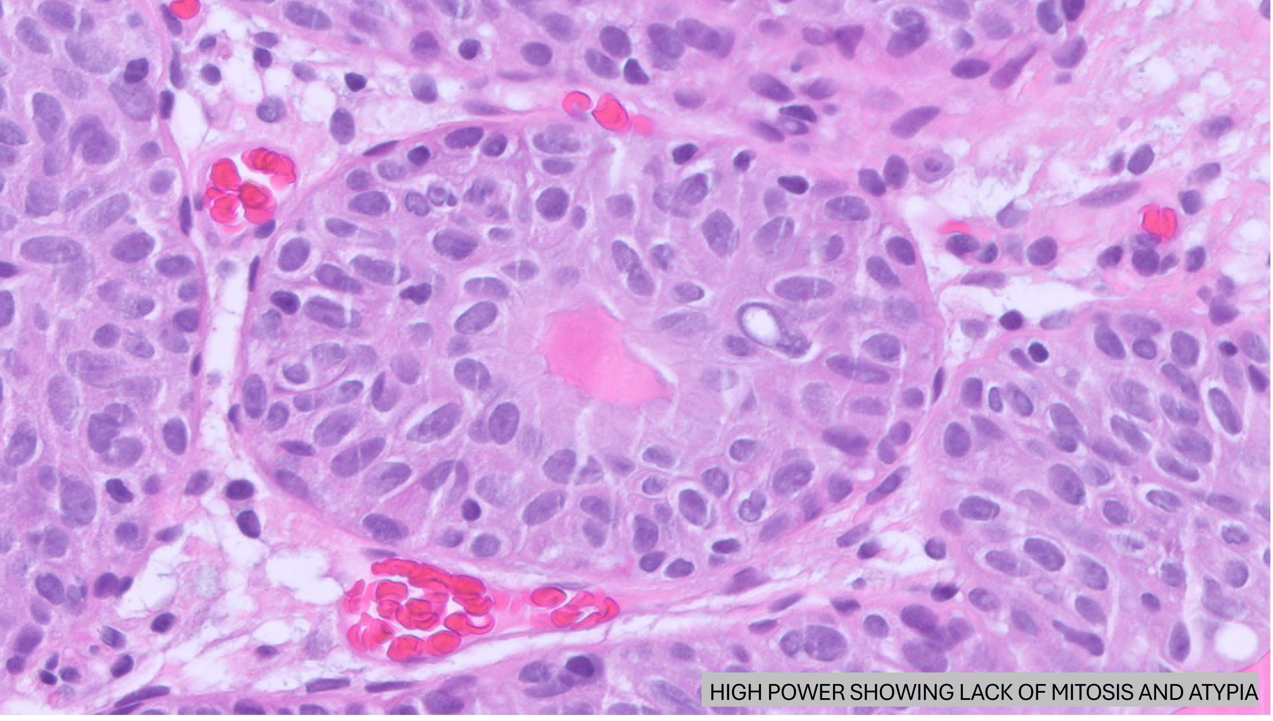 Microscopic image possibly detecting cancerous areas in human tissue