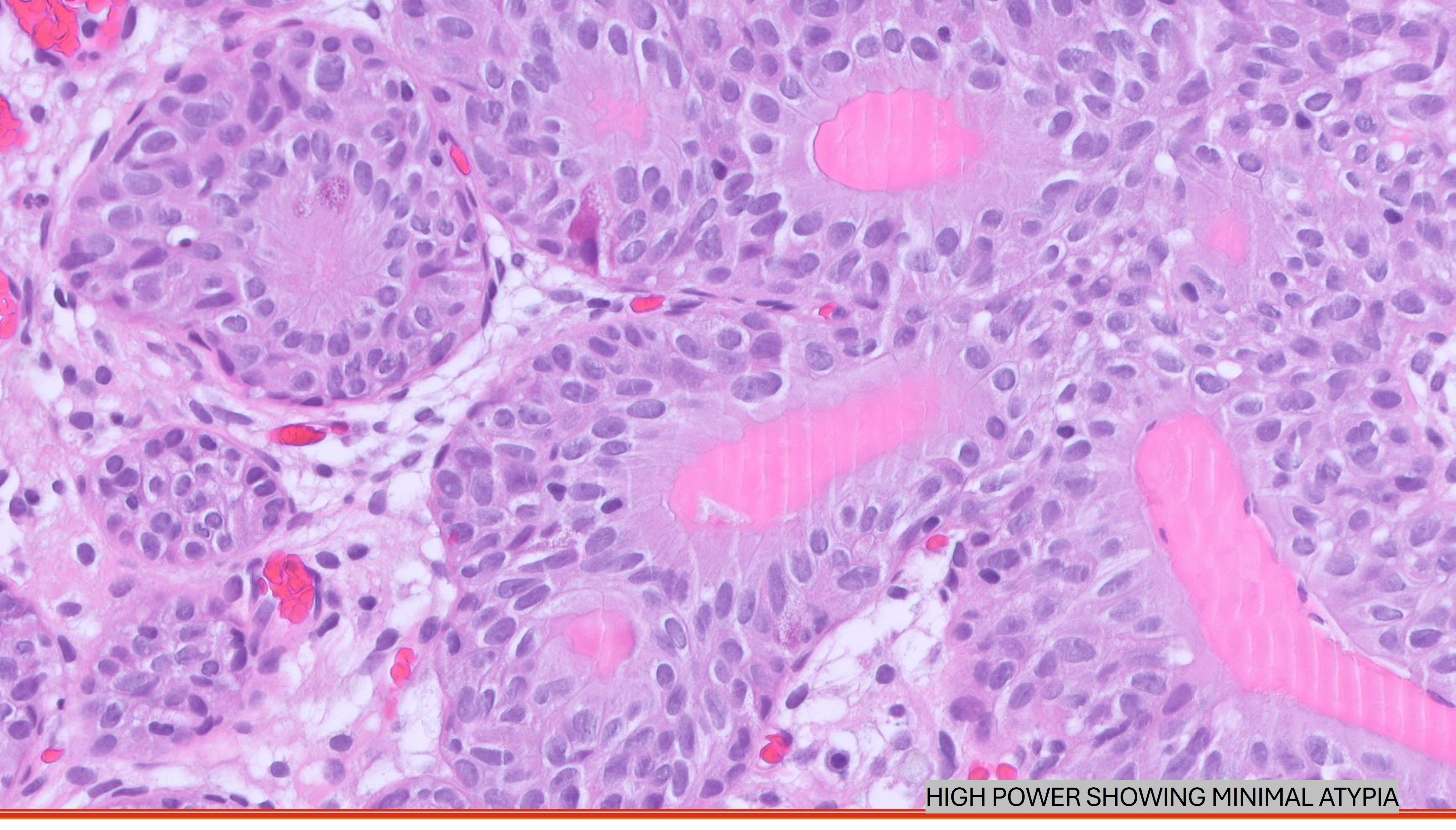 Microscopic image possibly detecting cancerous areas in human tissue