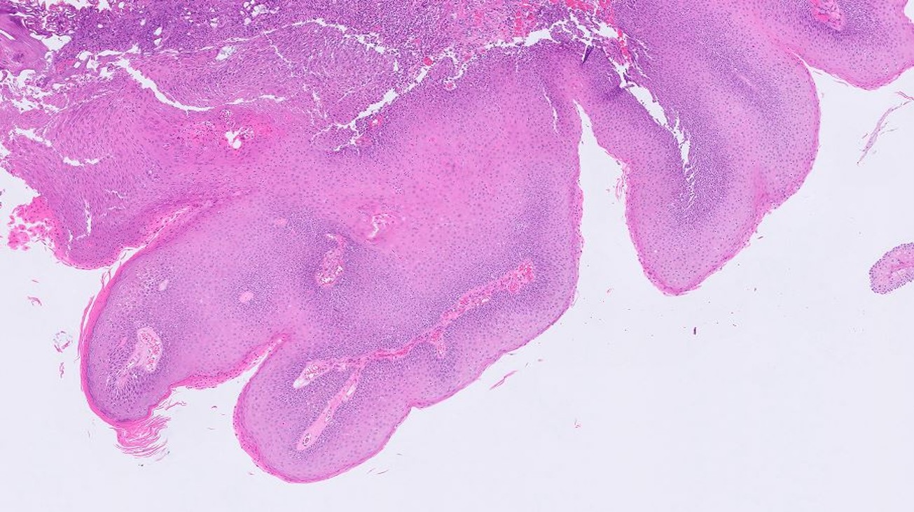Microscopic image possibly detecting cancerous areas in human tissue