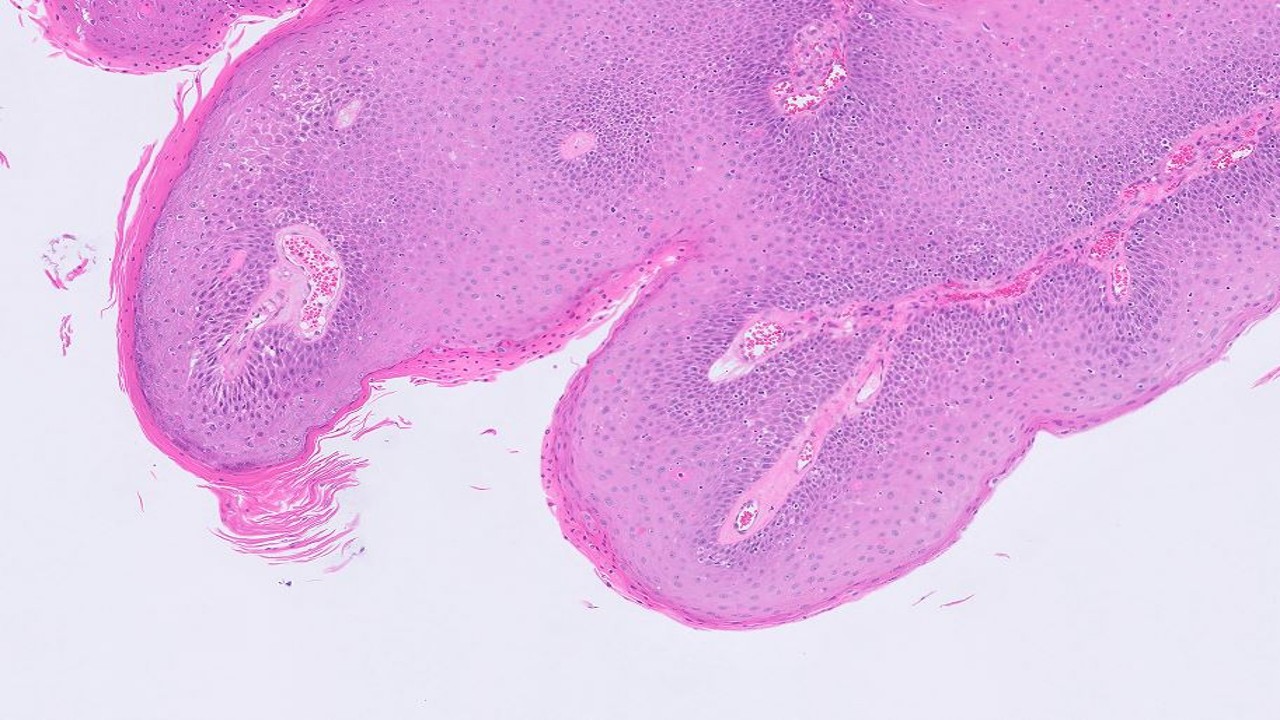 Microscopic image possibly detecting cancerous areas in human tissue