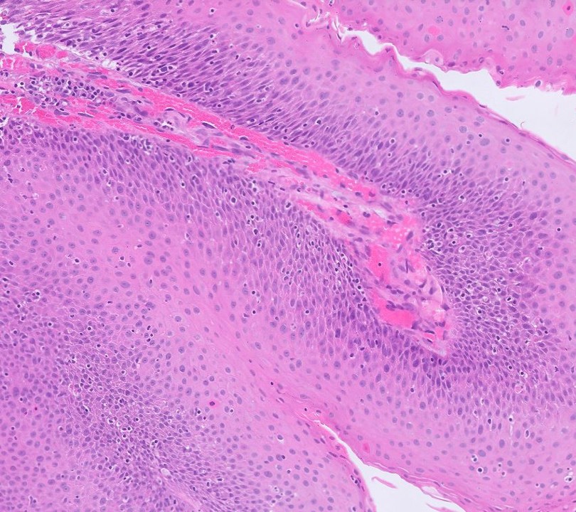 Microscopic image possibly detecting cancerous areas in human tissue