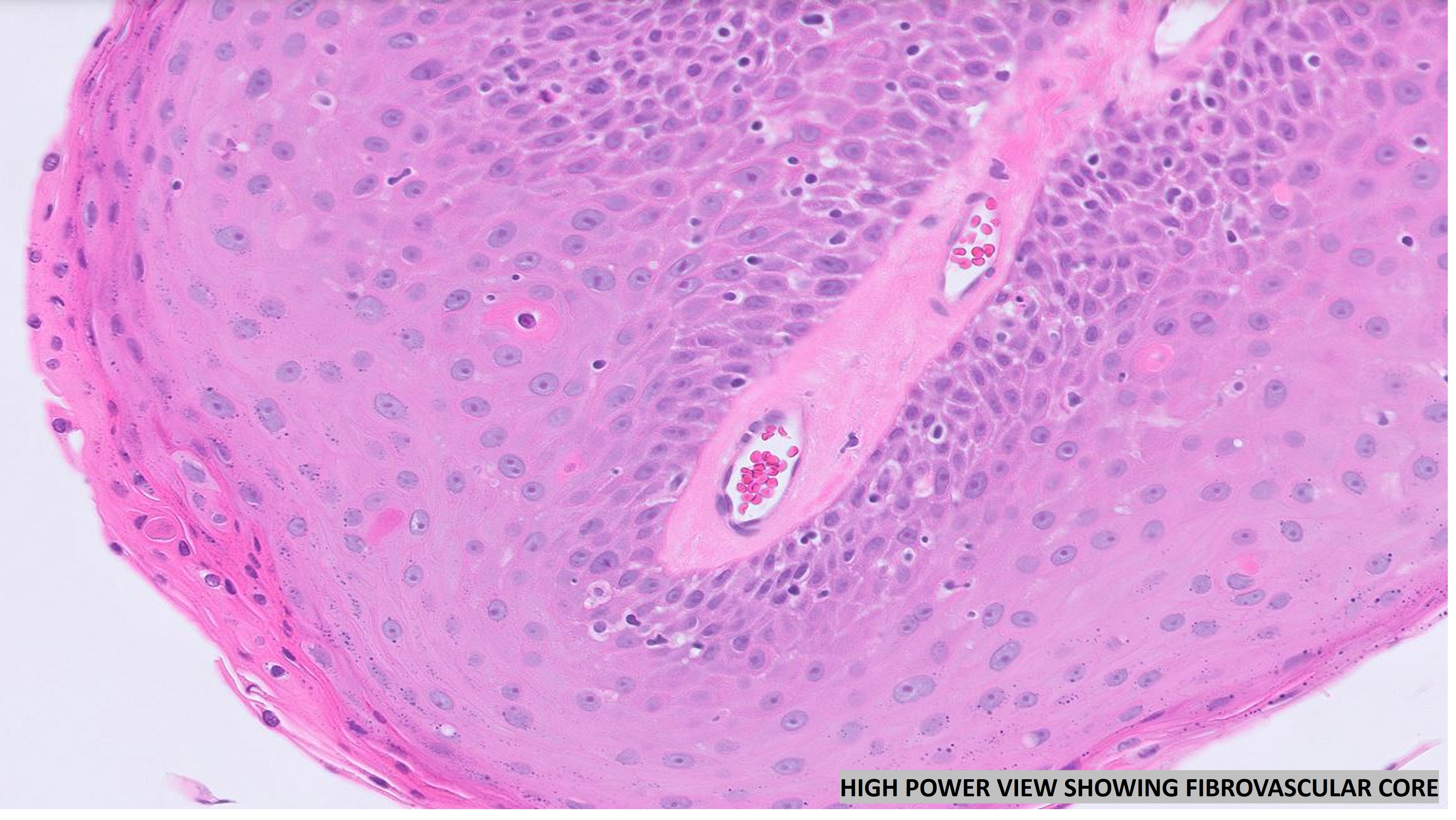 Microscopic image possibly detecting cancerous areas in human tissue