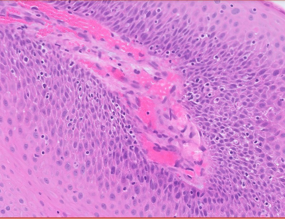 Microscopic image possibly detecting cancerous areas in human tissue