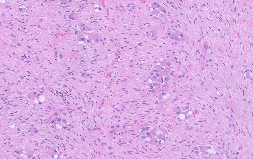 Microscopic image possibly detecting cancerous areas in human tissue