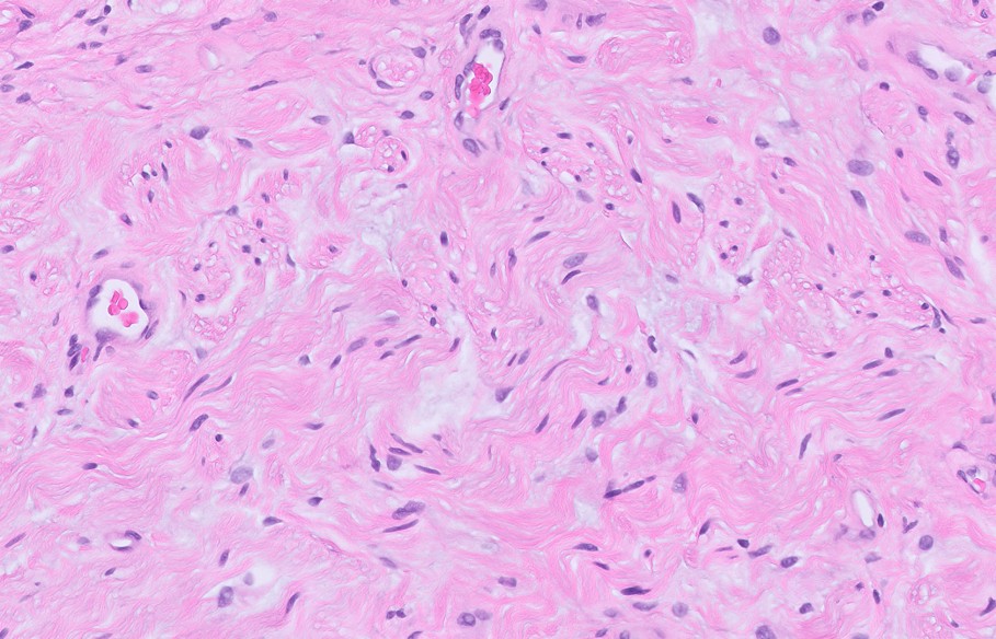 Microscopic image possibly detecting cancerous areas in human tissue