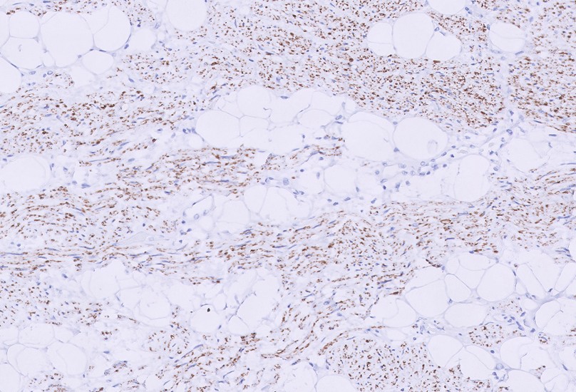 Microscopic image possibly detecting cancerous areas in human tissue