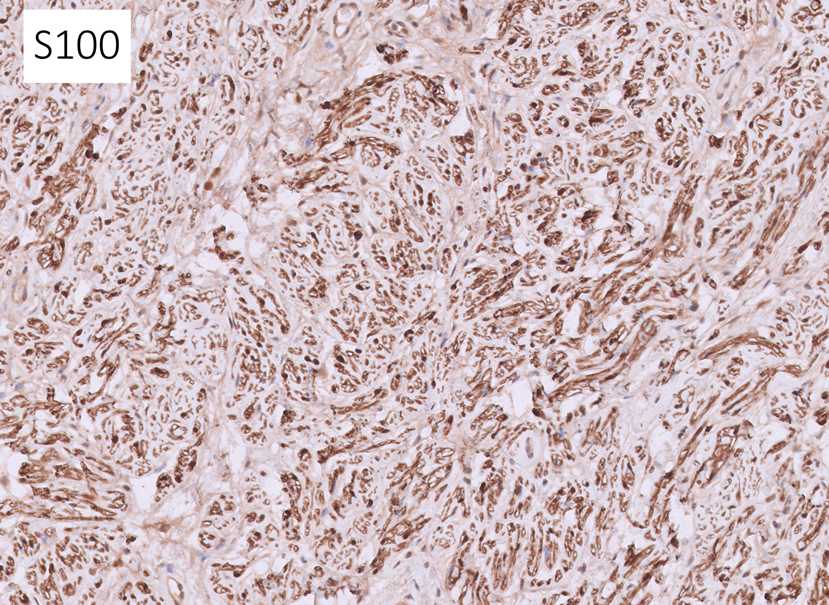 Microscopic image possibly detecting cancerous areas in human tissue