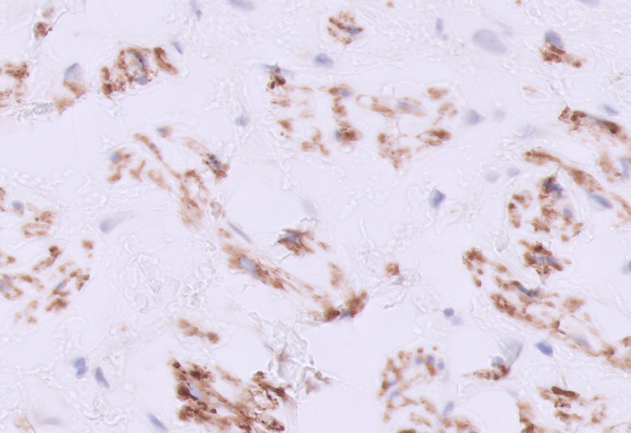 Microscopic image possibly detecting cancerous areas in human tissue