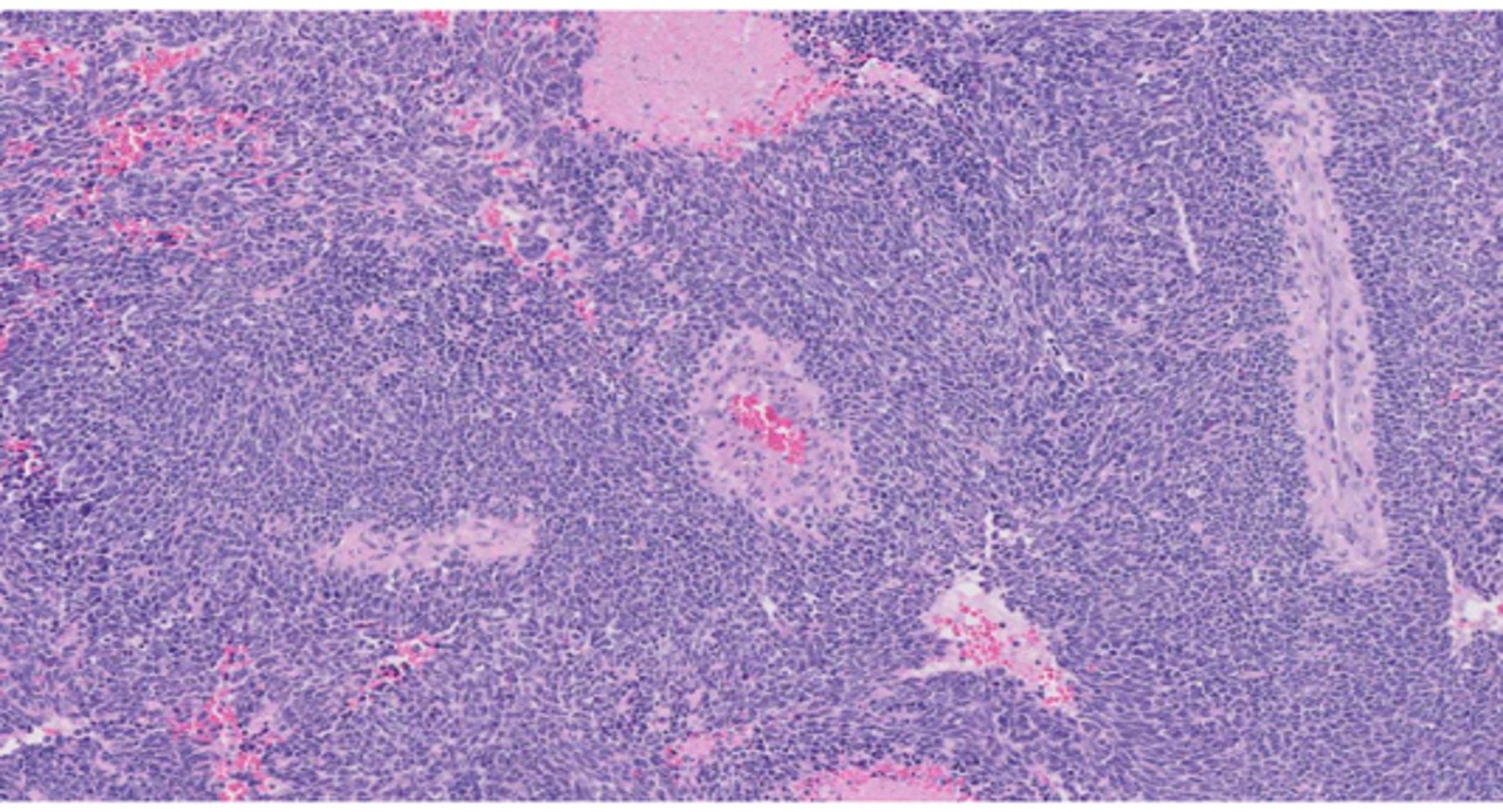 Microscopic image possibly detecting cancerous areas in human tissue