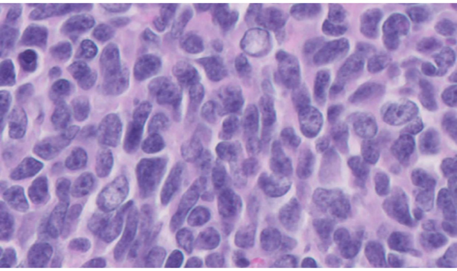 Microscopic image possibly detecting cancerous areas in human tissue