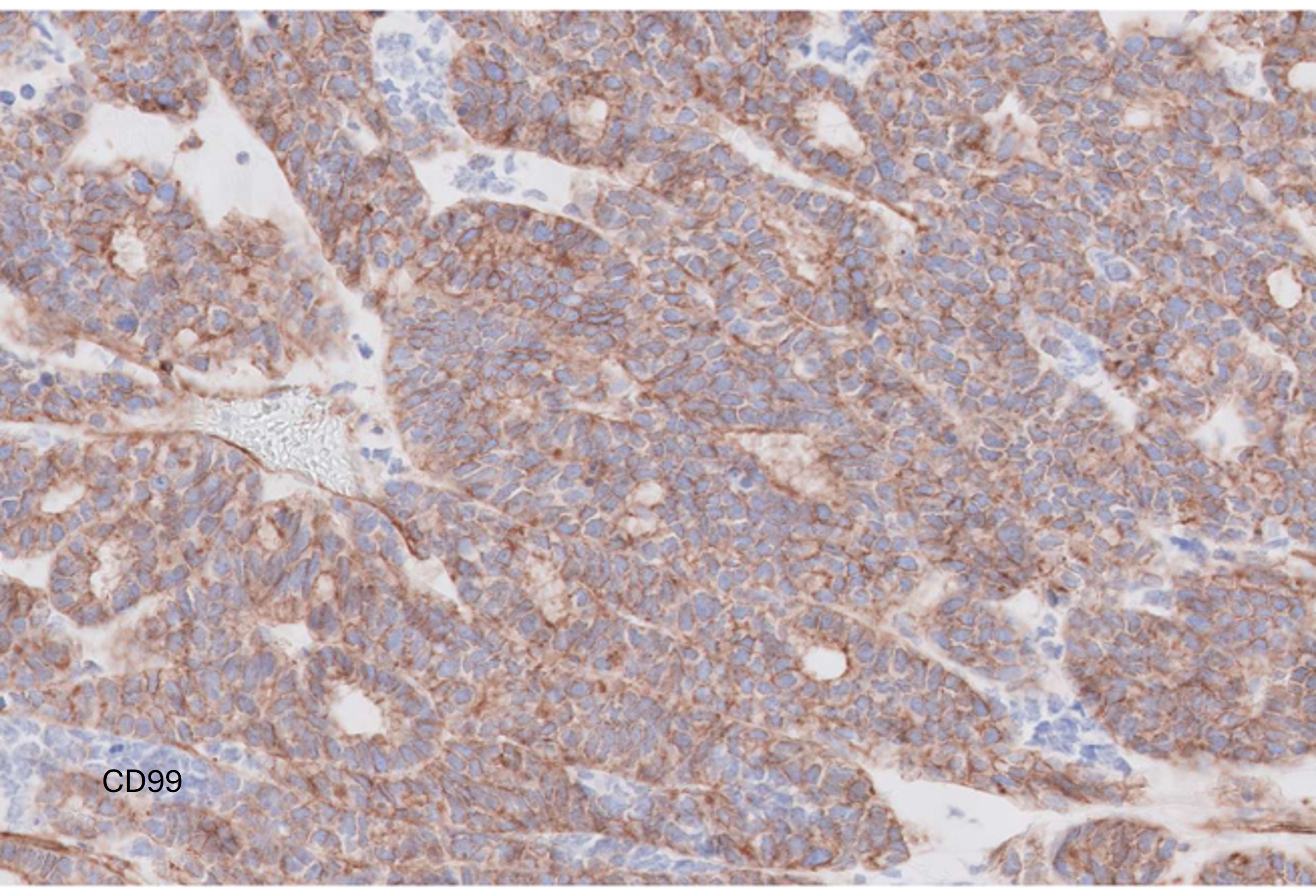 Microscopic image possibly detecting cancerous areas in human tissue