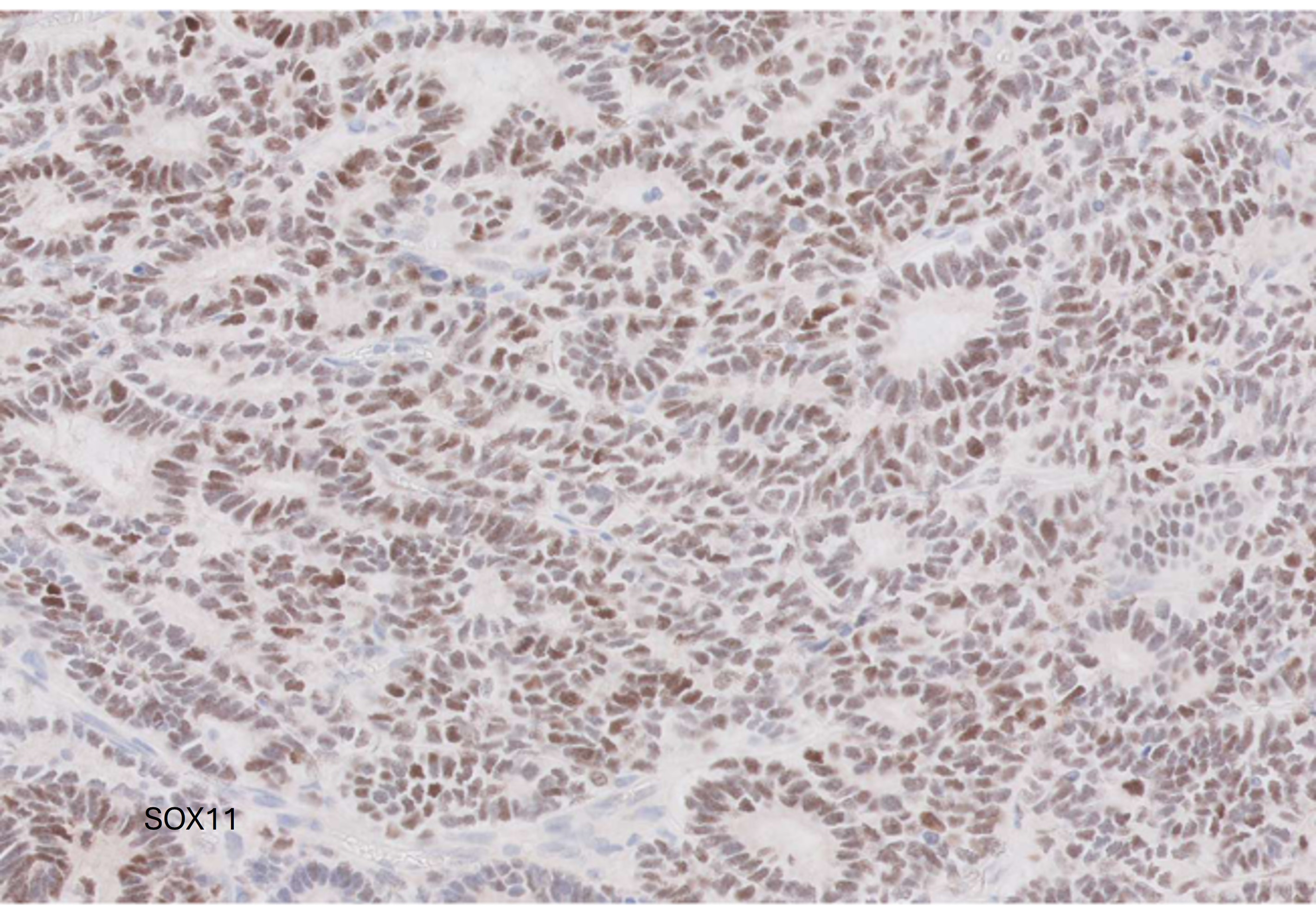 Microscopic image possibly detecting cancerous areas in human tissue