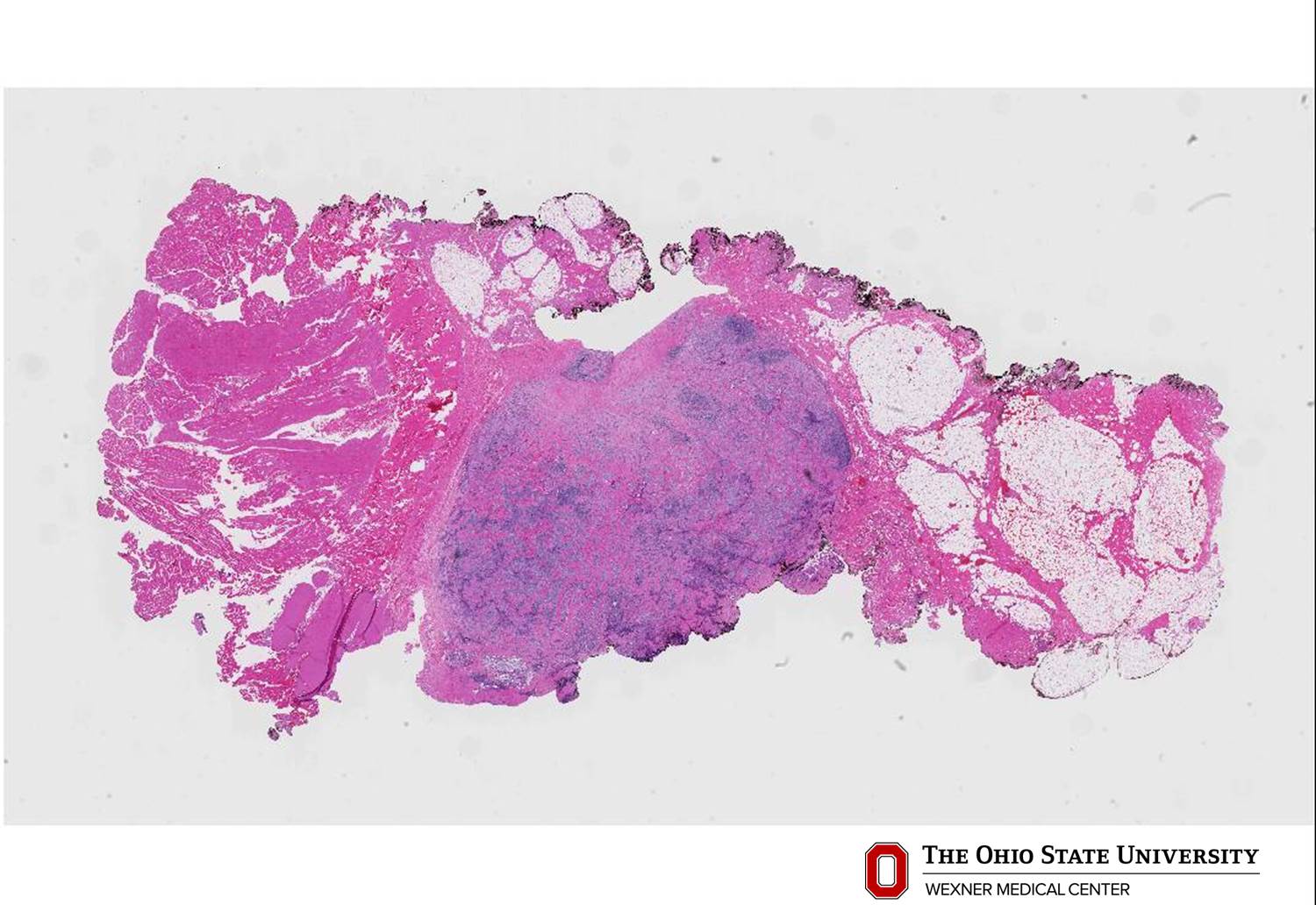 Microscopic image possibly detecting cancerous areas in human tissue