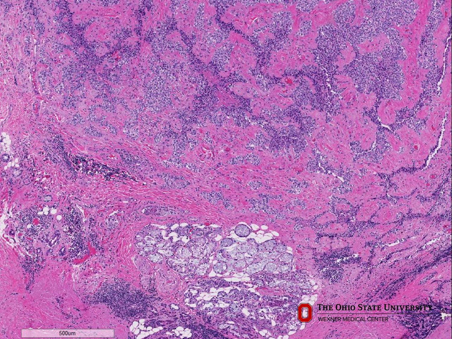 Microscopic image possibly detecting cancerous areas in human tissue