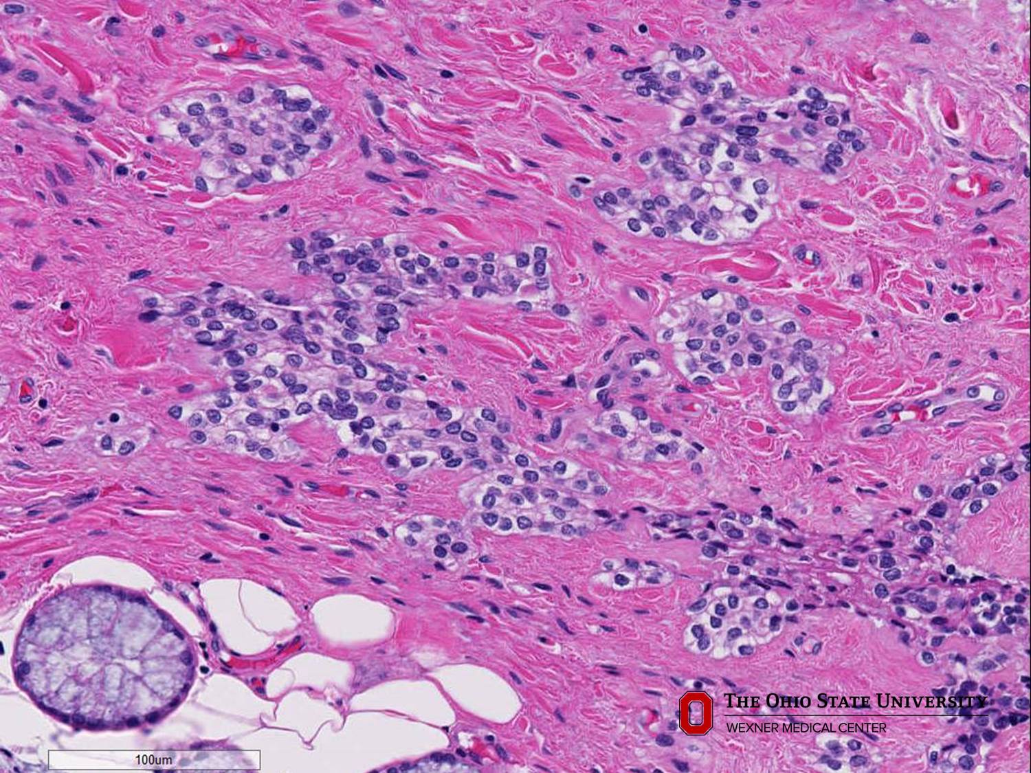 Microscopic image possibly detecting cancerous areas in human tissue