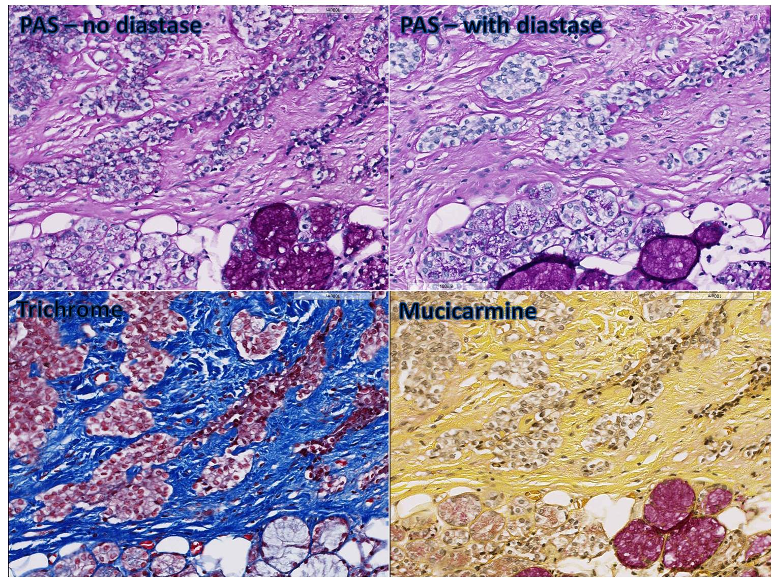 Microscopic image possibly detecting cancerous areas in human tissue