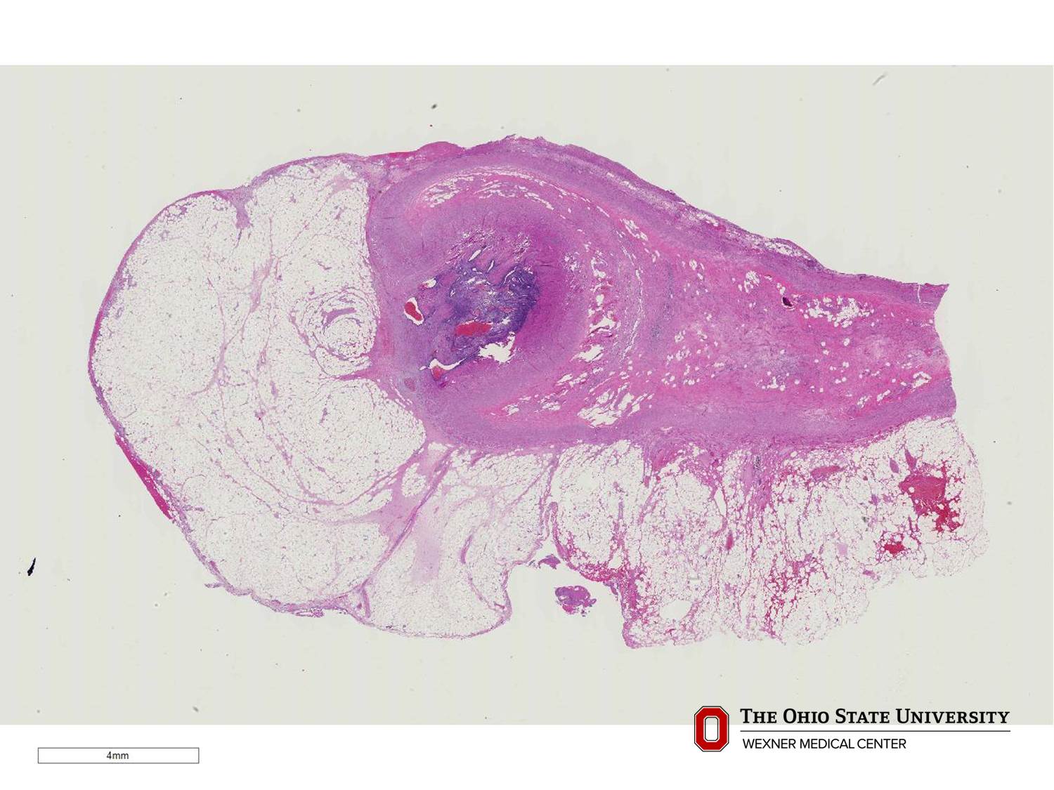 Microscopic image possibly detecting cancerous areas in human tissue