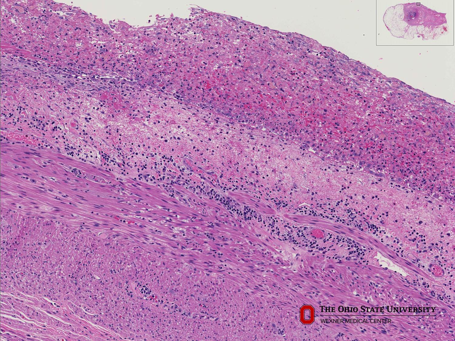 Microscopic image possibly detecting cancerous areas in human tissue