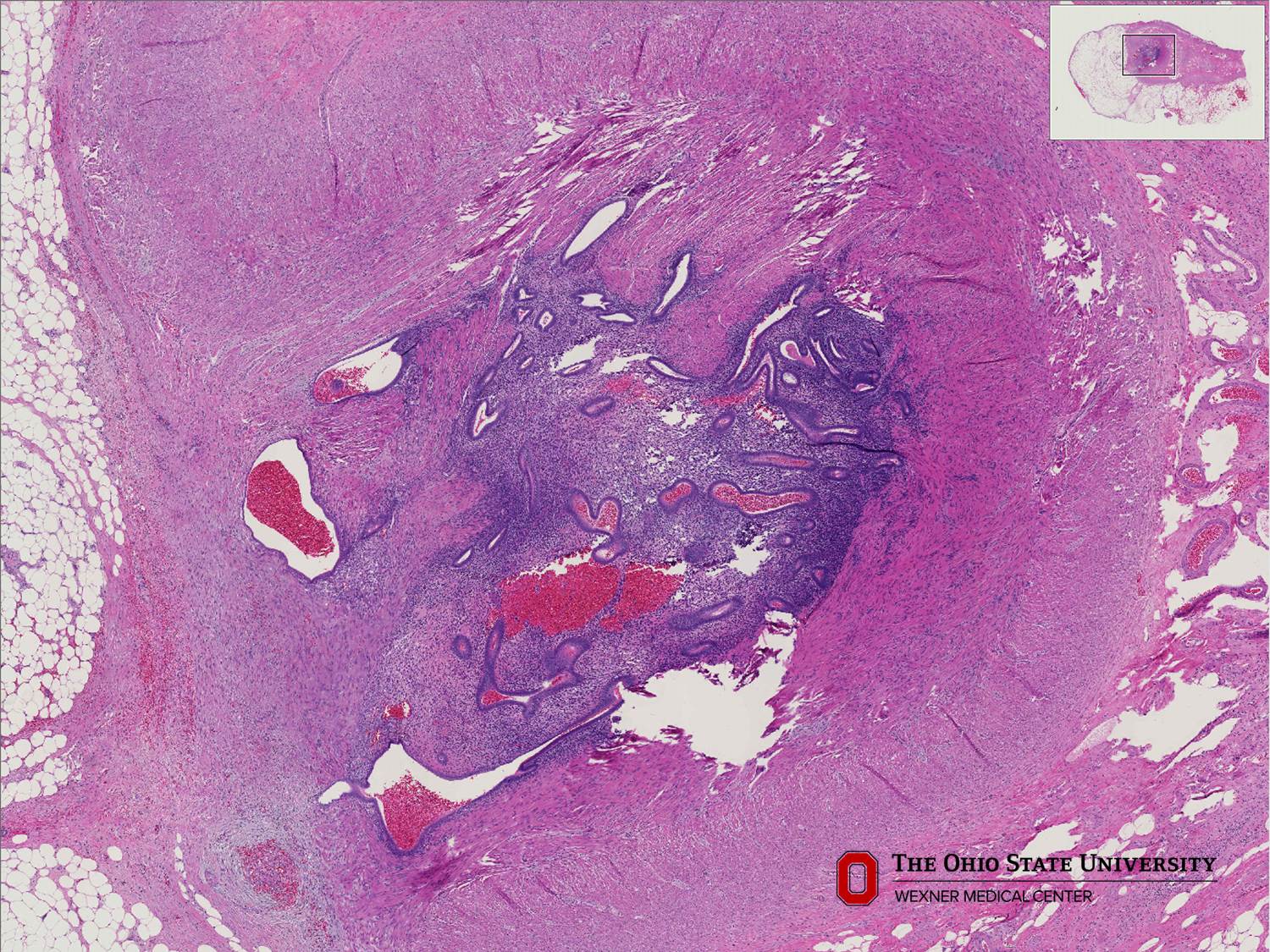 Microscopic image possibly detecting cancerous areas in human tissue