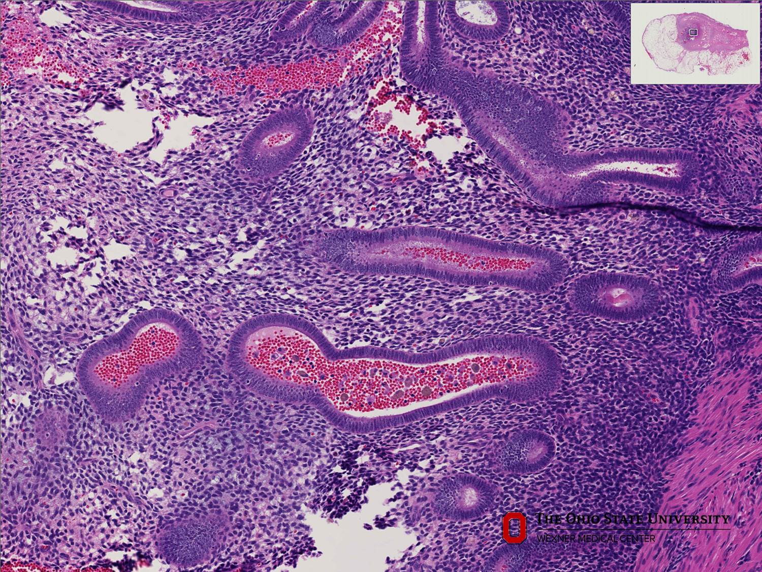 Microscopic image possibly detecting cancerous areas in human tissue