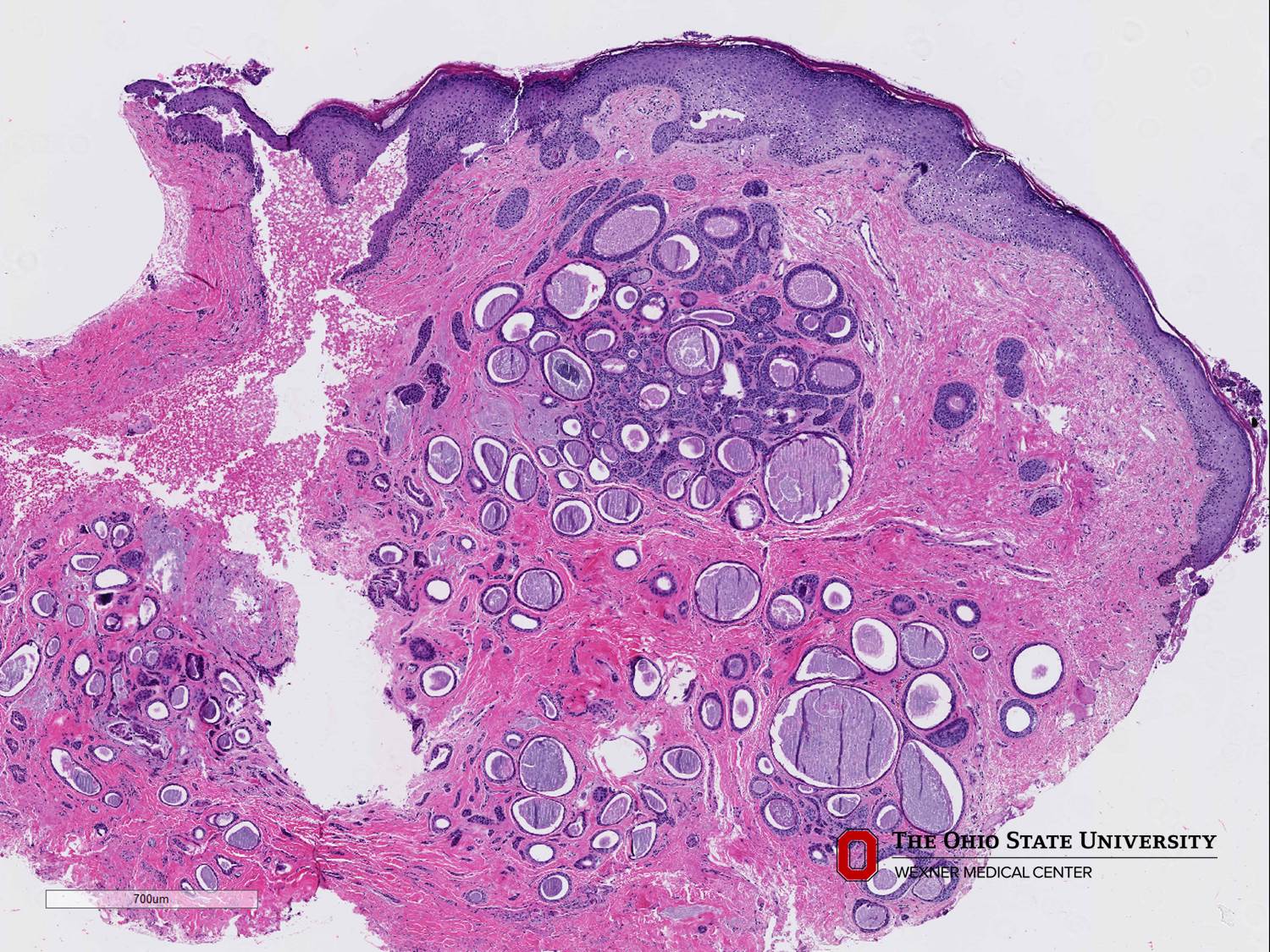 Microscopic image possibly detecting cancerous areas in human tissue