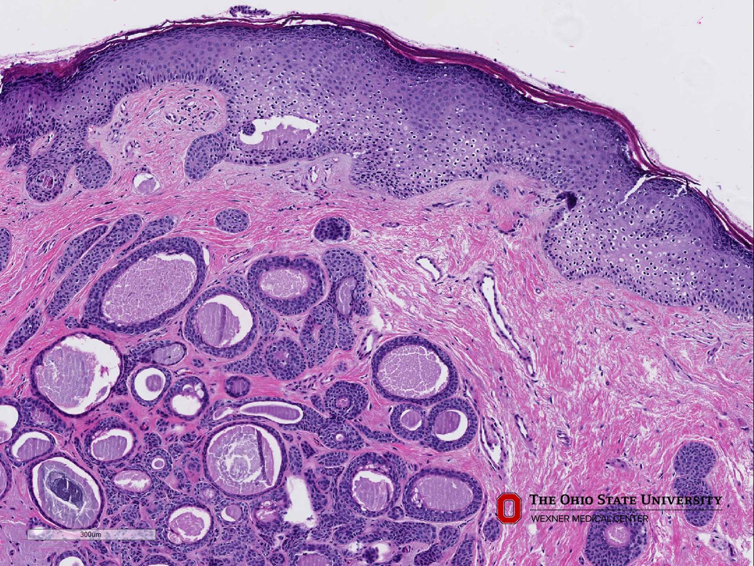 Microscopic image possibly detecting cancerous areas in human tissue