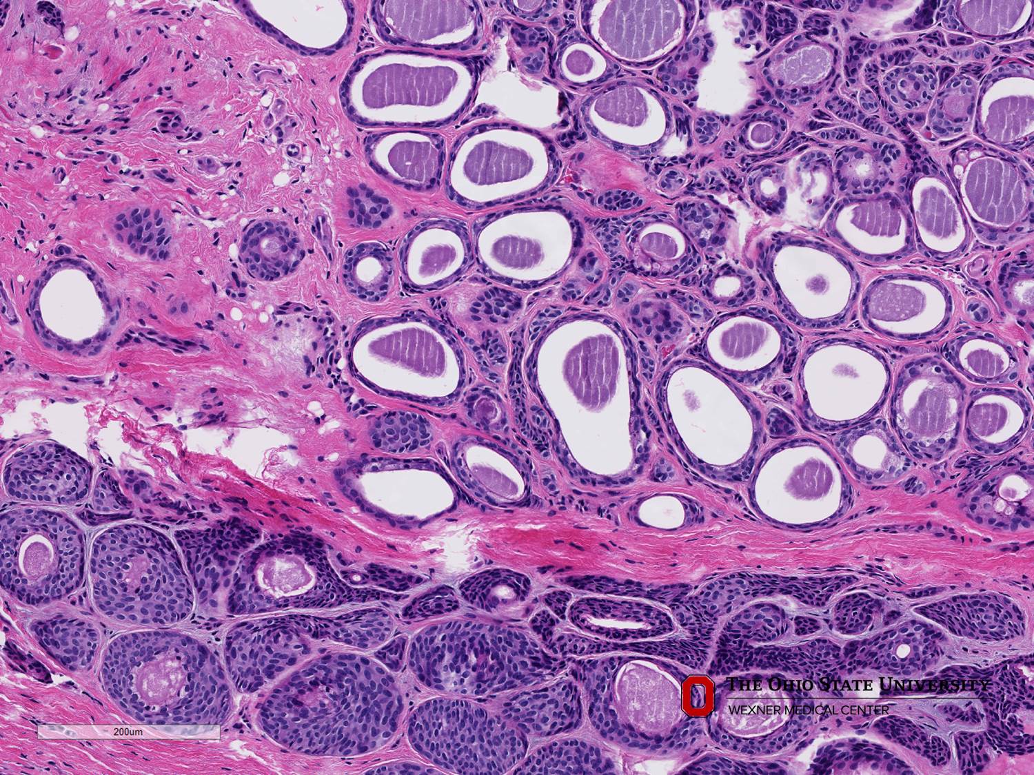 Microscopic image possibly detecting cancerous areas in human tissue