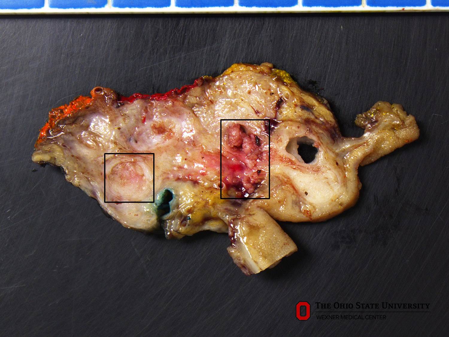 Microscopic image possibly detecting cancerous areas in human tissue