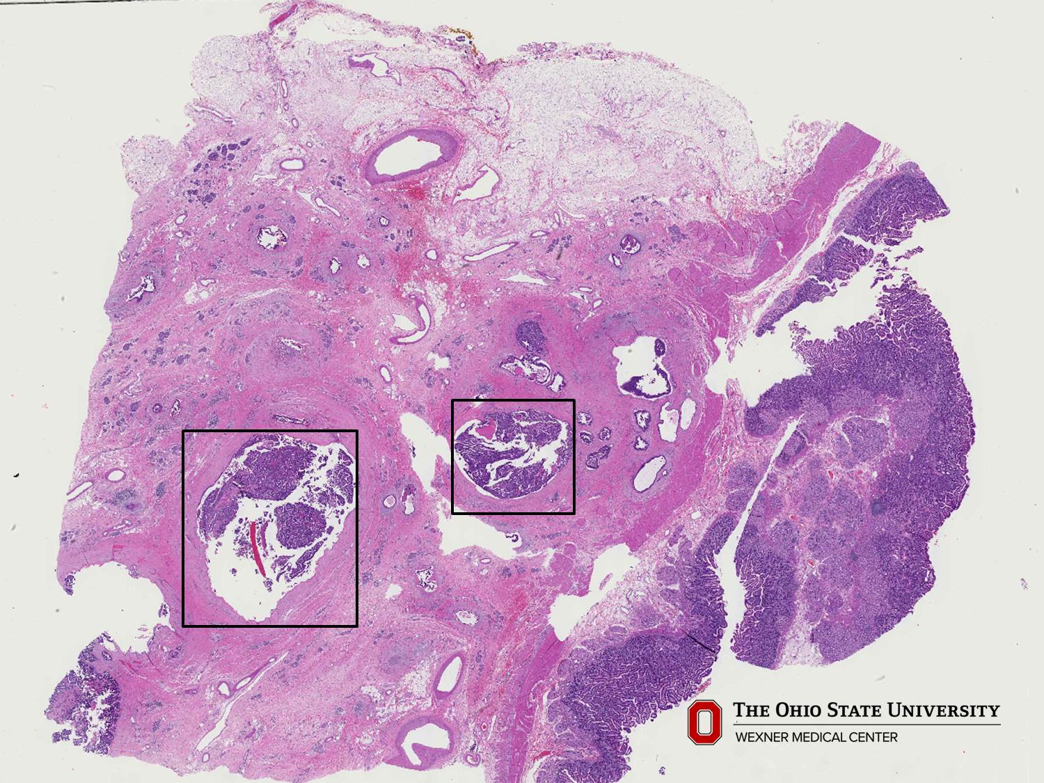 Microscopic image possibly detecting cancerous areas in human tissue