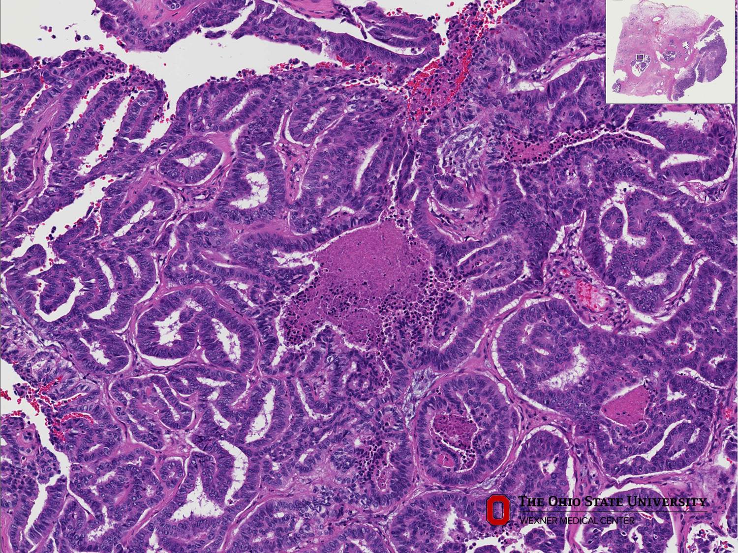 Microscopic image possibly detecting cancerous areas in human tissue