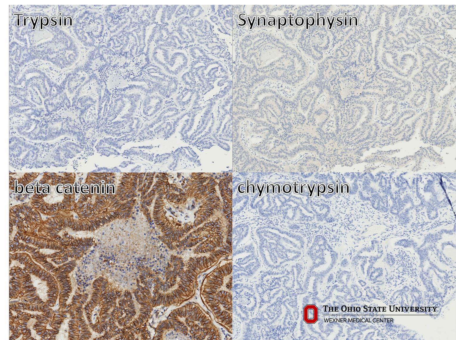 Microscopic image possibly detecting cancerous areas in human tissue