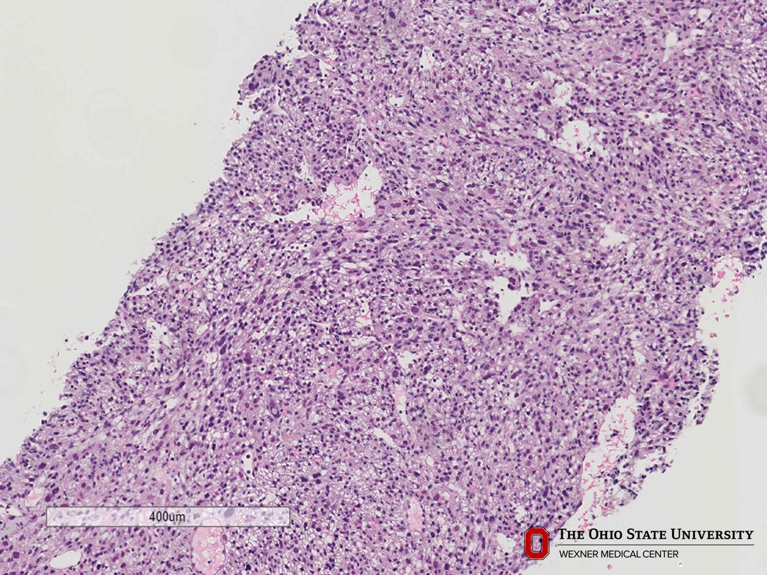 Microscopic image possibly detecting cancerous areas in human tissue