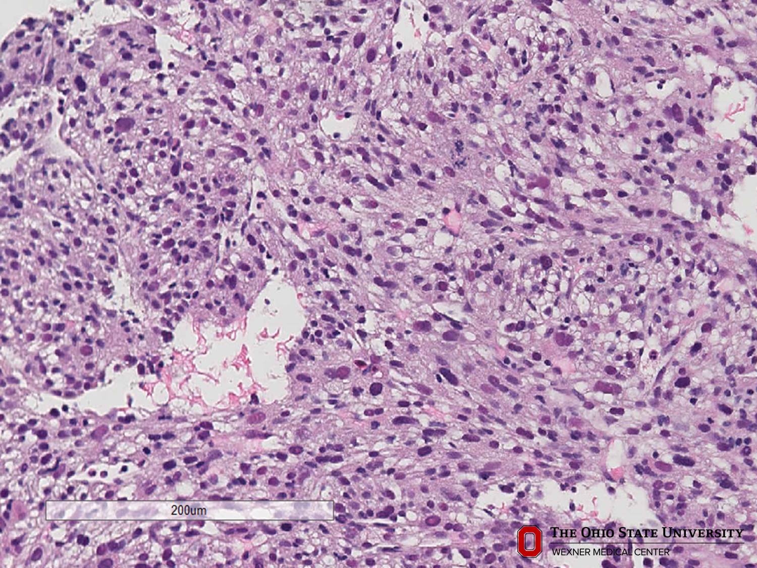 Microscopic image possibly detecting cancerous areas in human tissue