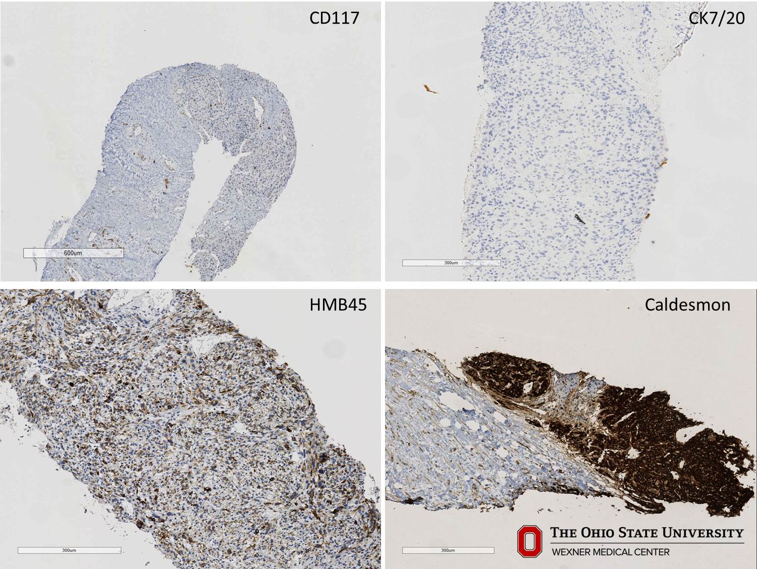 Microscopic image possibly detecting cancerous areas in human tissue