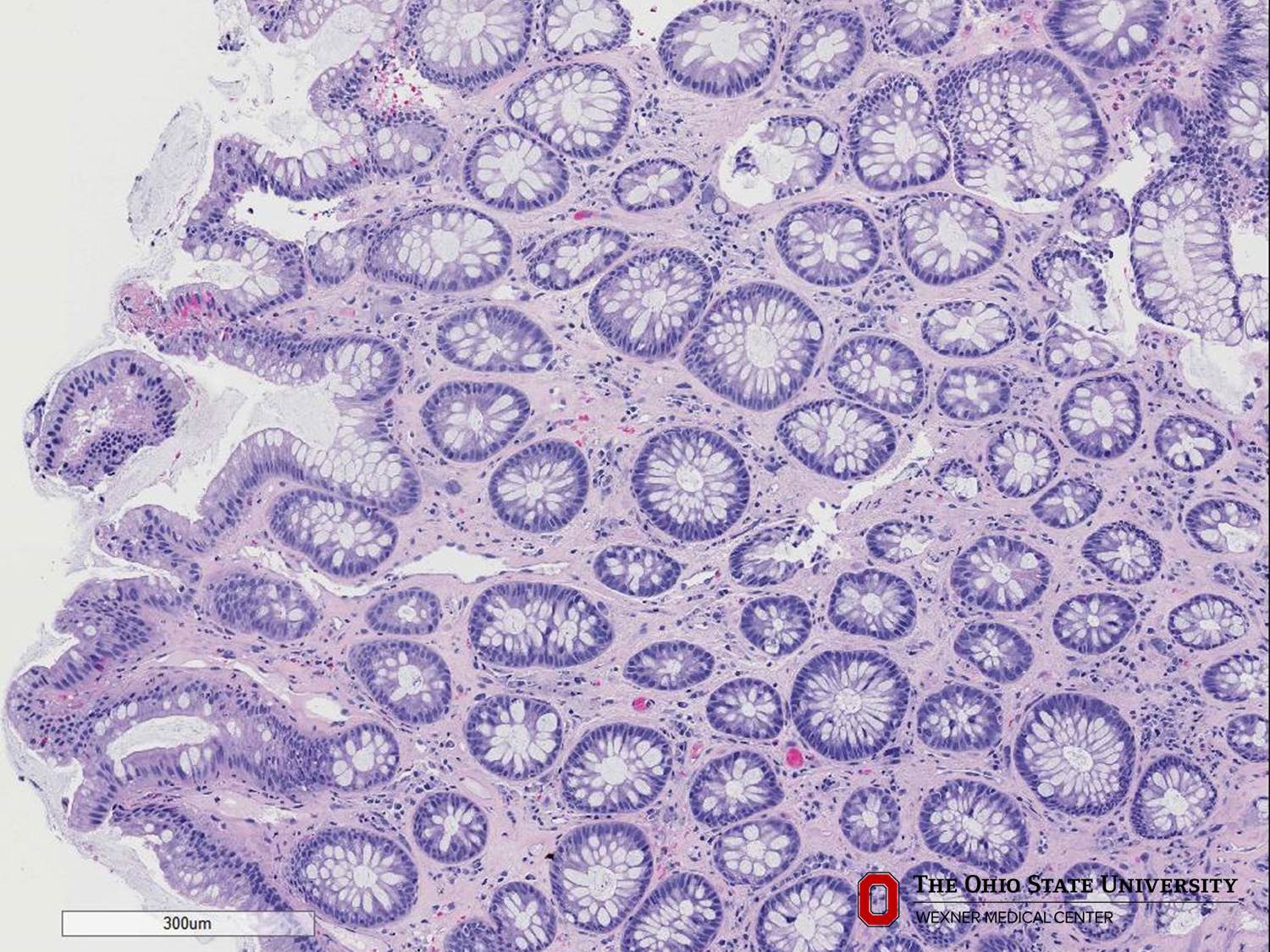 Microscopic image possibly detecting cancerous areas in human tissue