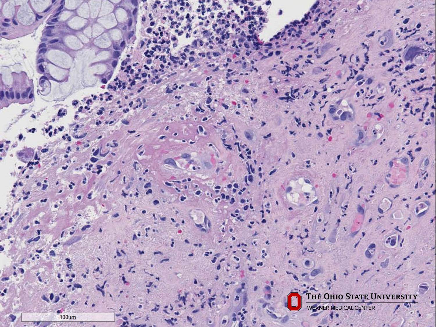 Microscopic image possibly detecting cancerous areas in human tissue