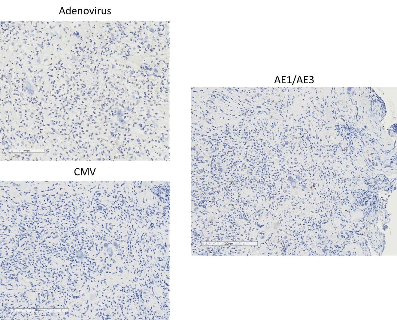 Microscopic image possibly detecting cancerous areas in human tissue