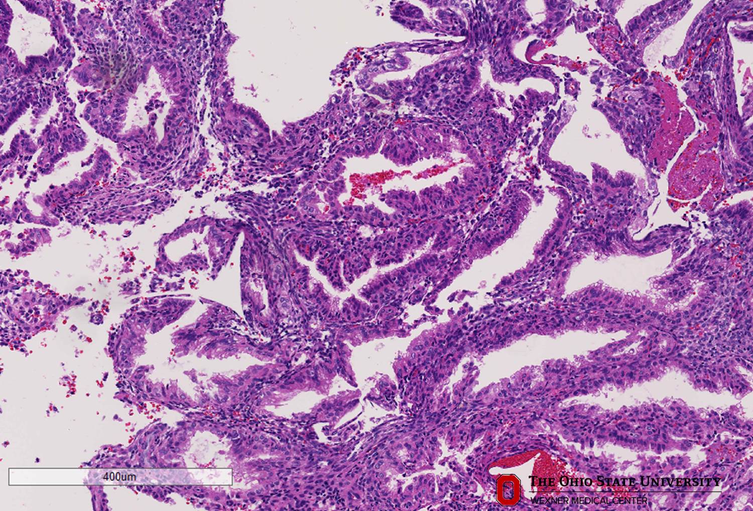 Microscopic image possibly detecting cancerous areas in human tissue