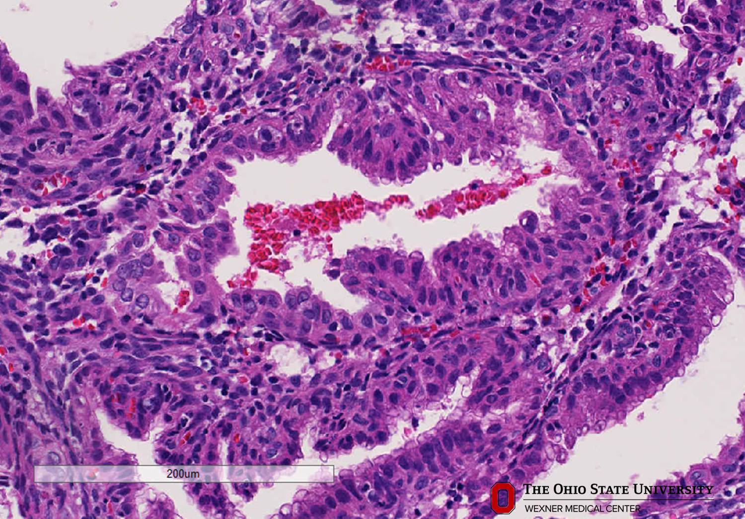 Microscopic image possibly detecting cancerous areas in human tissue