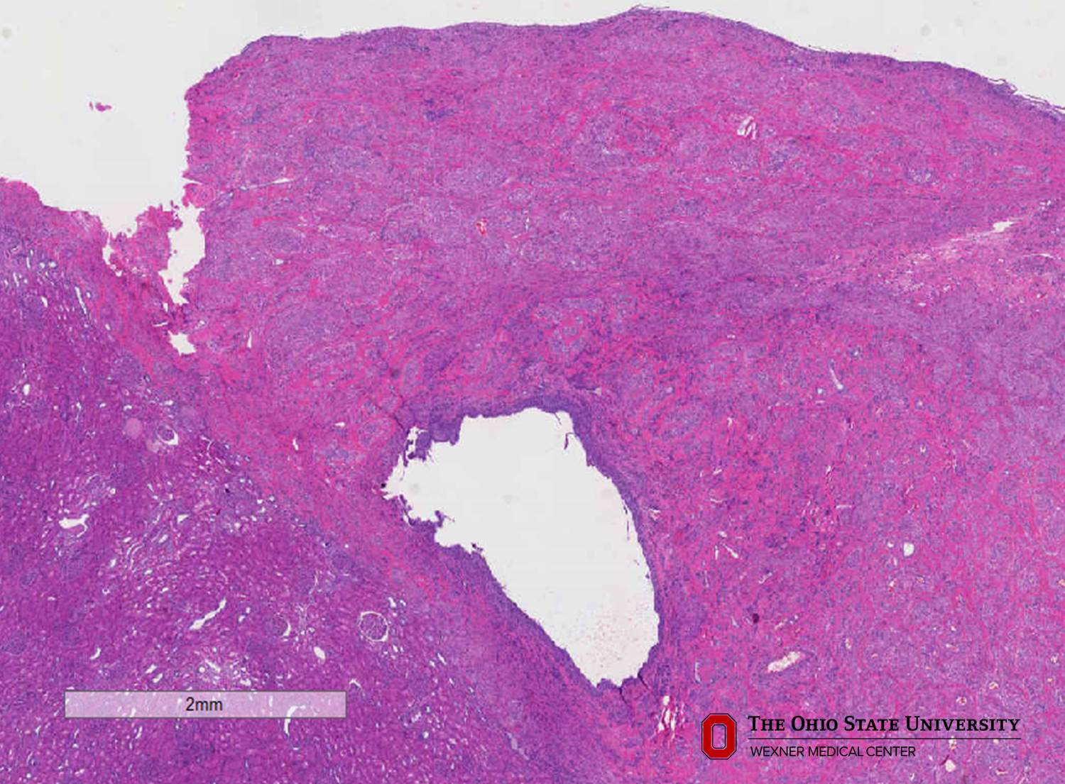 Microscopic image possibly detecting cancerous areas in human tissue