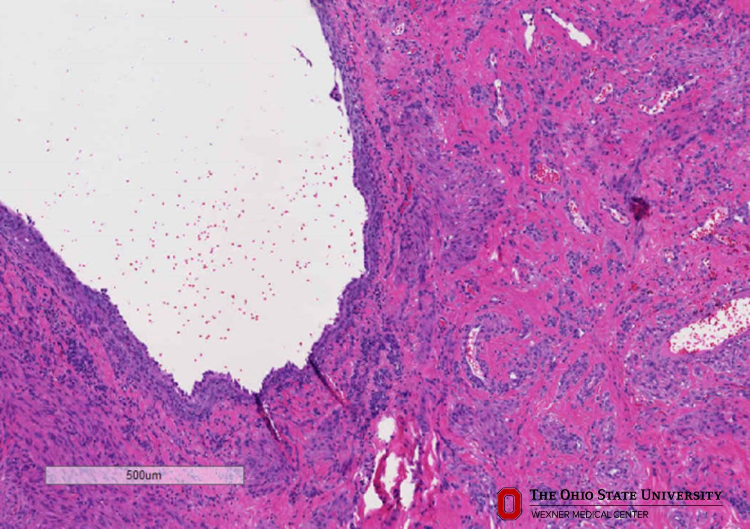 Microscopic image possibly detecting cancerous areas in human tissue