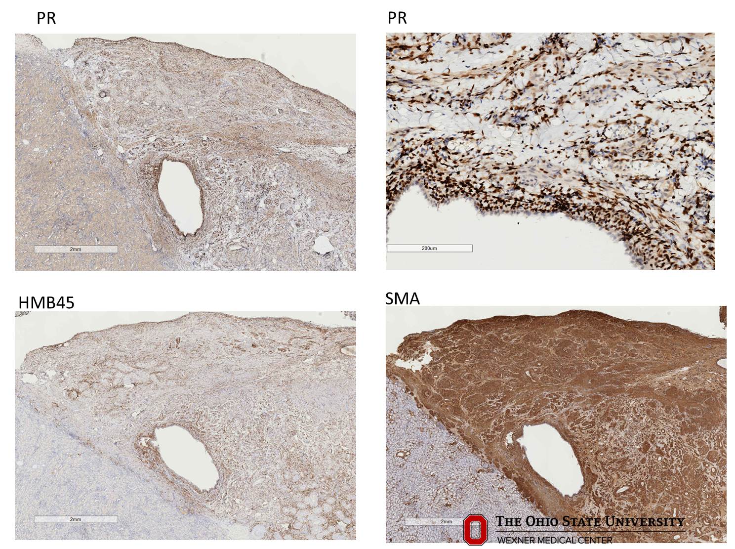 Microscopic image possibly detecting cancerous areas in human tissue