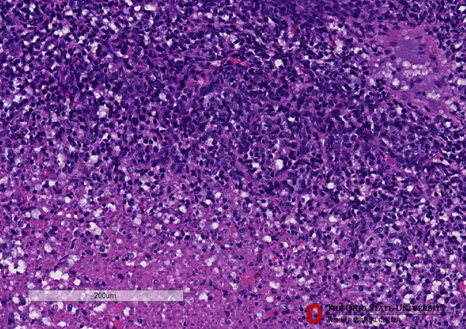 Microscopic image possibly detecting cancerous areas in human tissue