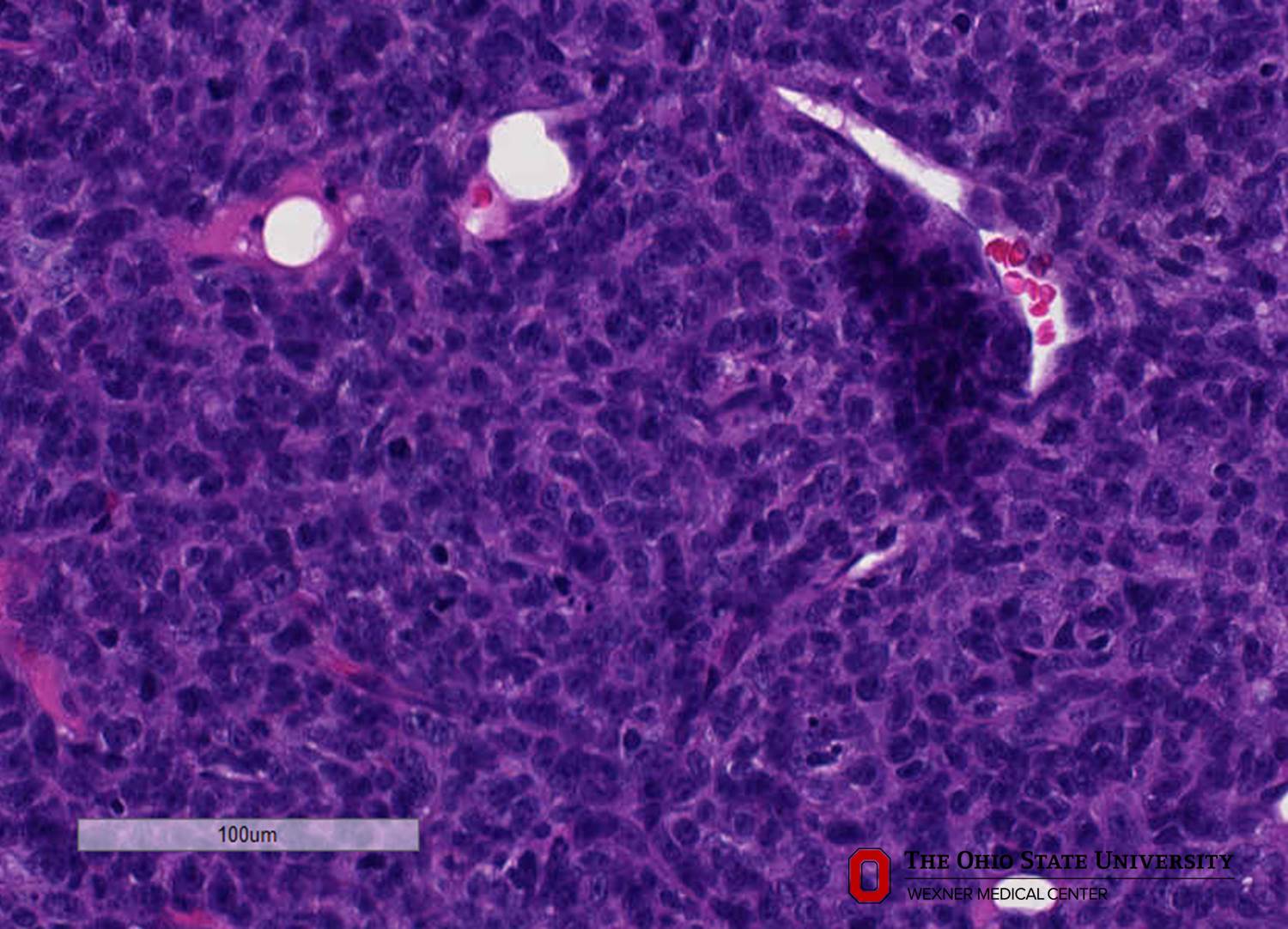 Microscopic image possibly detecting cancerous areas in human tissue