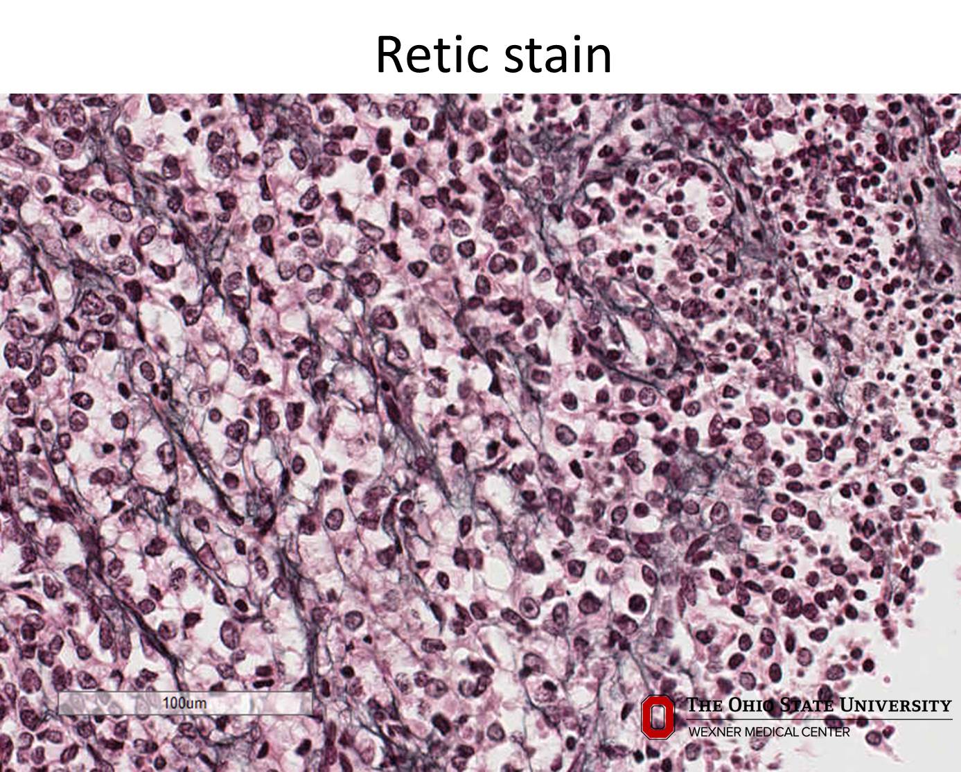 Microscopic image possibly detecting cancerous areas in human tissue