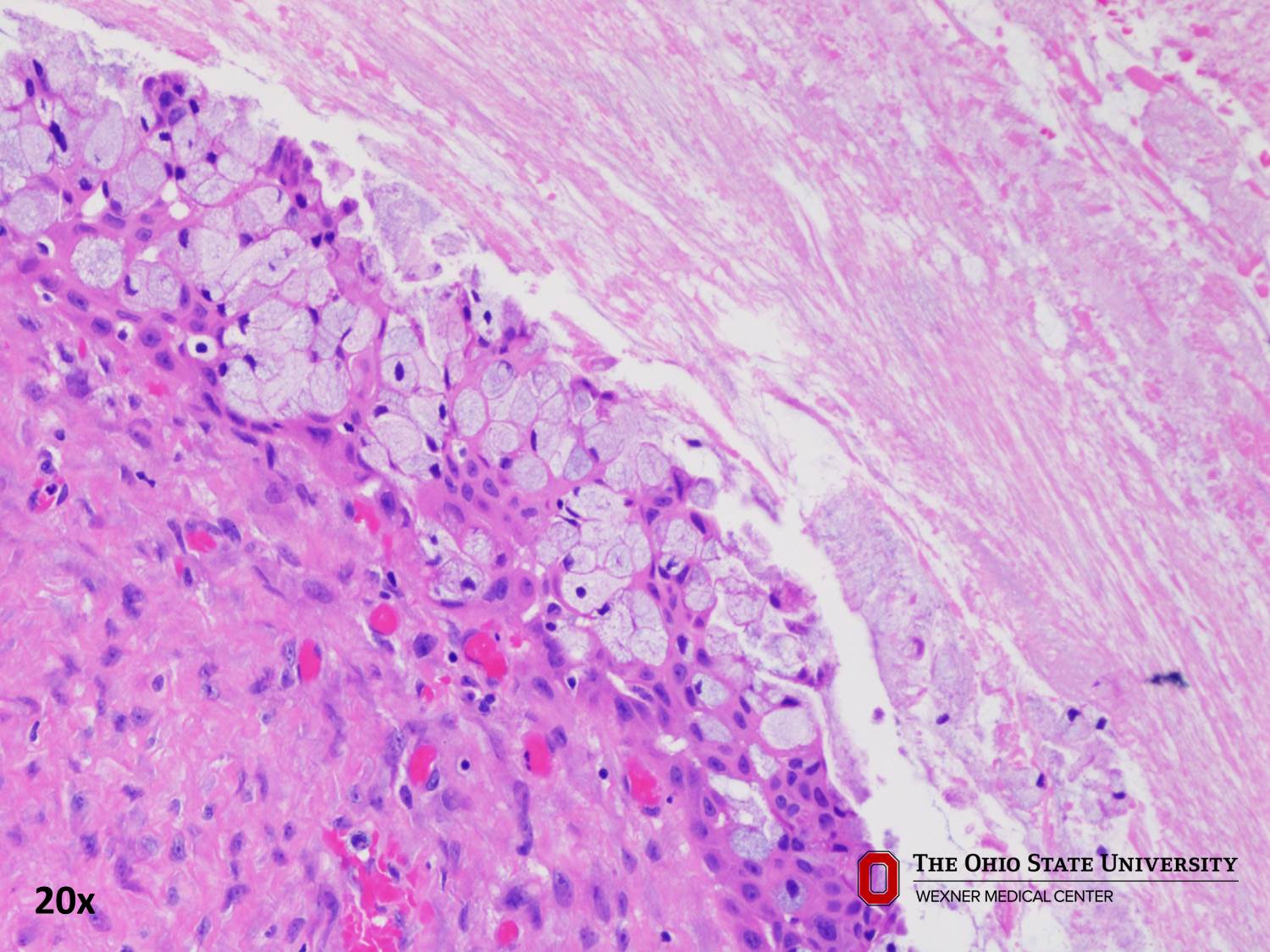 Microscopic image possibly detecting cancerous areas in human tissue